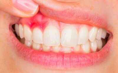 Parodontie au Luxembourg : les atouts la greffe gingivale