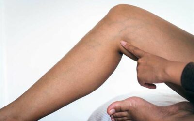 Traitement des varices au Luxembourg : un soin adapté