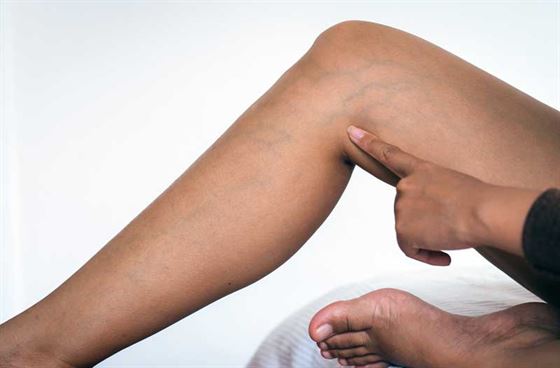 TRAITEMENT VARICES Traitement des varices au Luxembourg